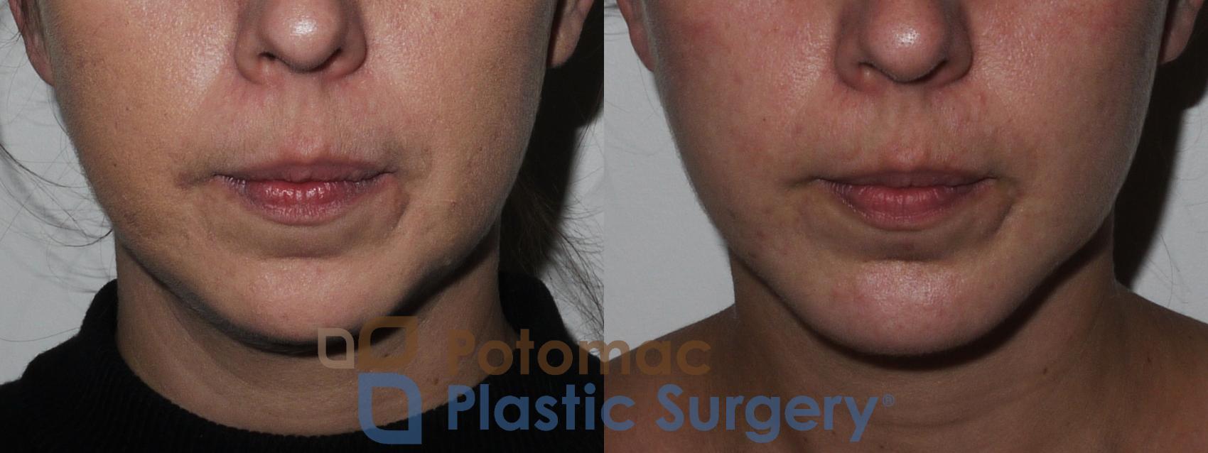 Before & After Chin Augmentation Case 201 Front View in Washington, DC