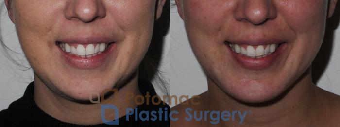 Before & After Chin Augmentation Case 201 Front View #2 View in Washington DC & Arlington , DC