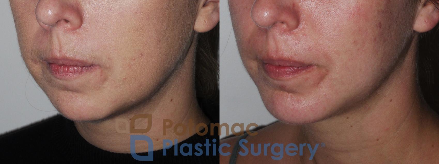 Before & After Chin Augmentation Case 201 Left Oblique View in Washington, DC