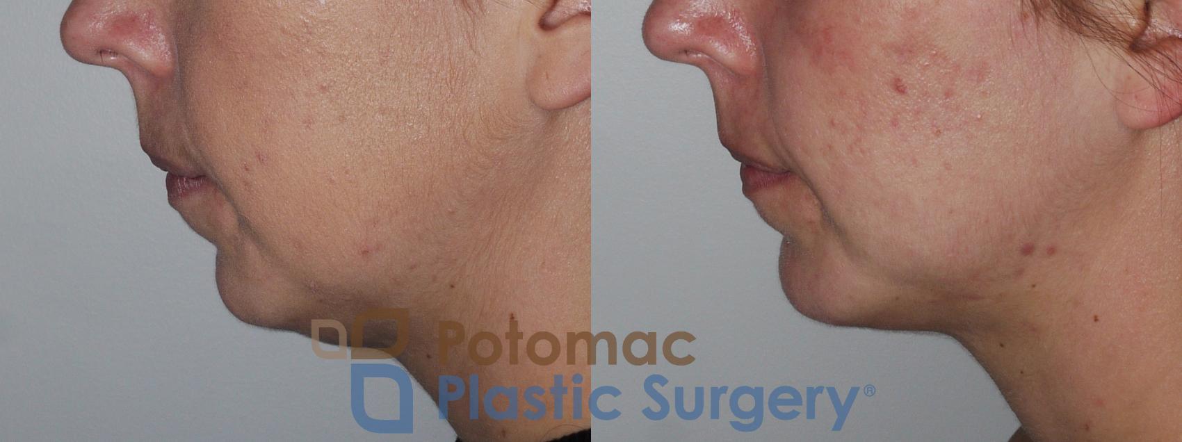 Before & After Chin Augmentation Case 201 Left Side View in Washington, DC