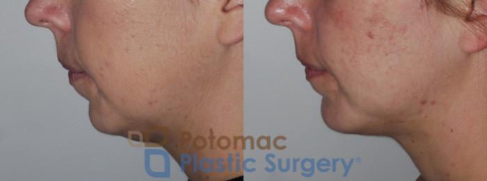 Before & After Facial Sculpting Case 201 Left Side View in Washington DC & Arlington , DC