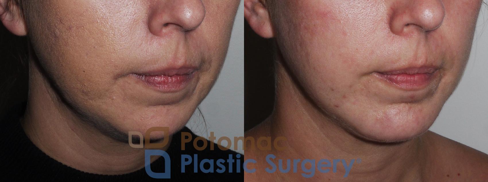 Before & After Chin Augmentation Case 201 Right Oblique View in Washington, DC
