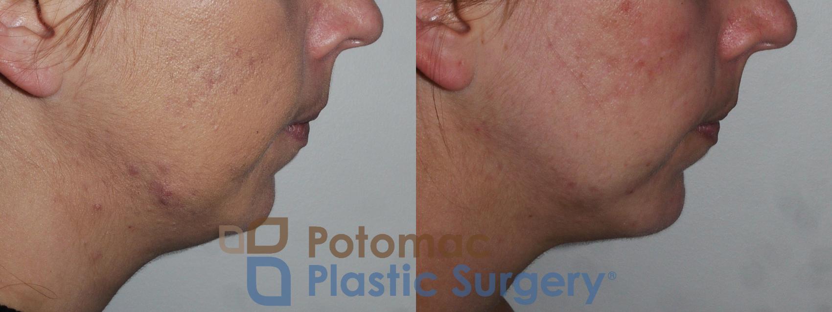 Before & After Chin Augmentation Case 201 Right Side View in Washington, DC