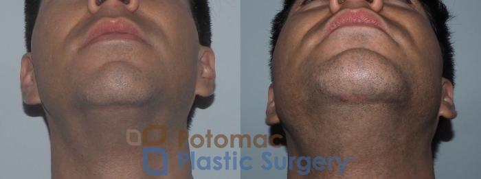 Before & After Chin Augmentation Case 208 Bottom View in Washington DC & Arlington , DC