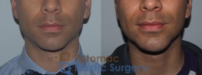 Before & After Chin Augmentation Case 208 Front View in Washington, DC