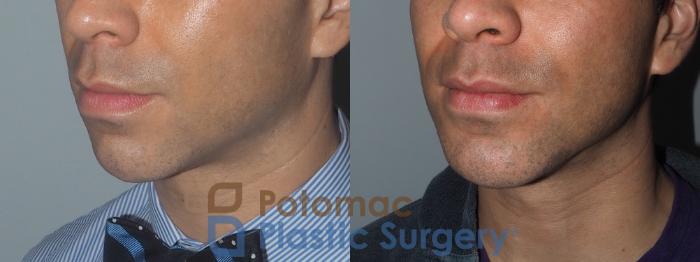 Before & After Chin Augmentation Case 208 Left Oblique View in Washington DC & Arlington , DC