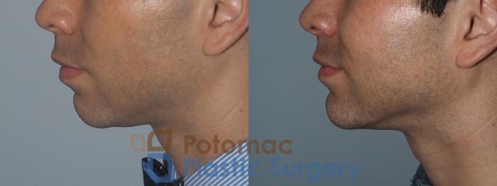 Before & After Chin Augmentation Case 208 Left Side View in Washington DC & Arlington , DC