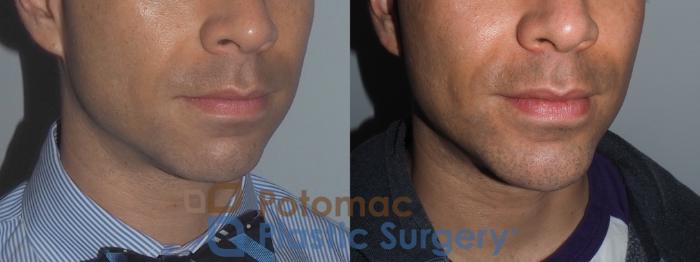 Before & After Chin Augmentation Case 208 Right Oblique View in Washington DC & Arlington , DC