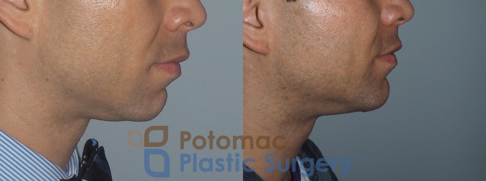 Before & After Chin Augmentation Case 208 Right Side View in Washington DC & Arlington , DC