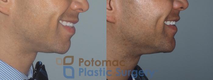 Before & After Liposuction Case 208 Right Side View #2 View in Washington DC & Arlington , DC