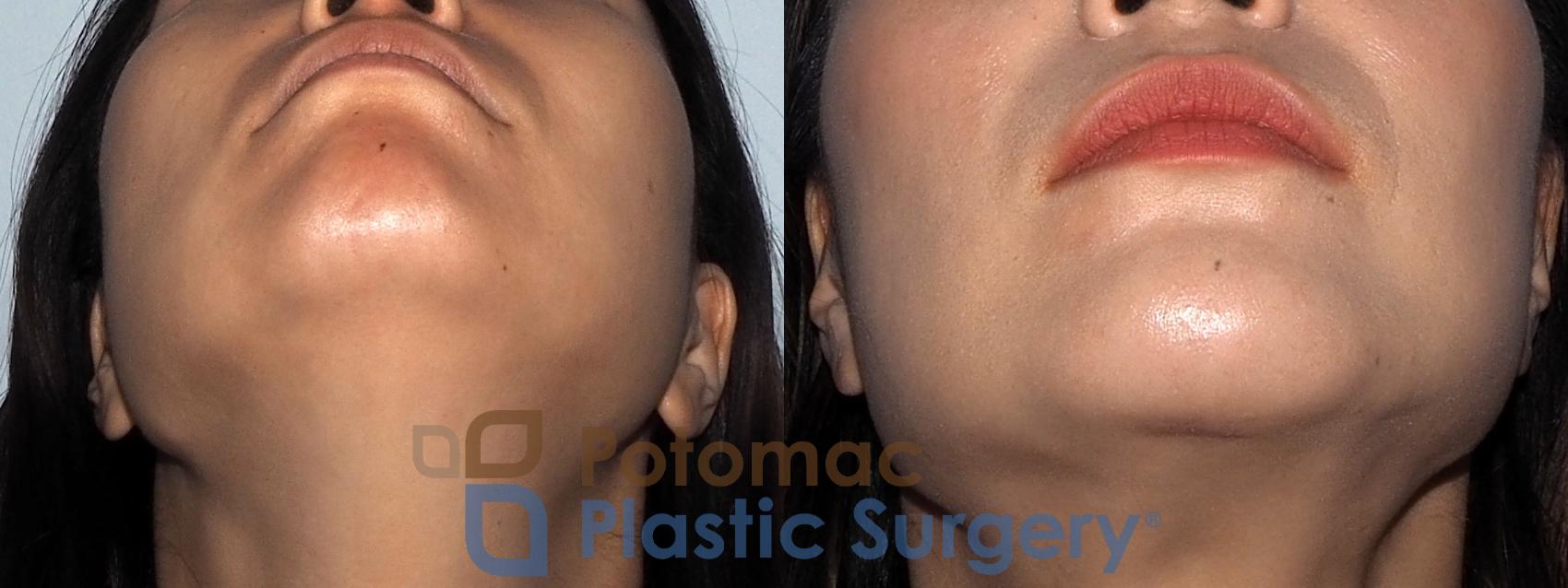 Before & After Chin Augmentation Case 214 Bottom View in Washington, DC