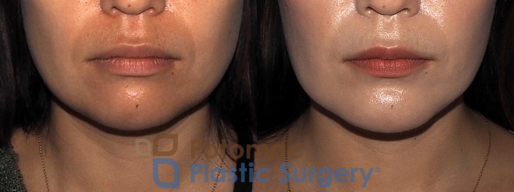 Before & After Chin Augmentation Case 214 Front View in Washington, DC