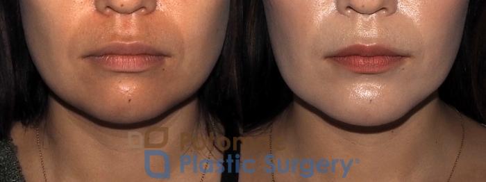Before & After Chin Augmentation Case 214 Front View in Washington DC & Arlington , DC