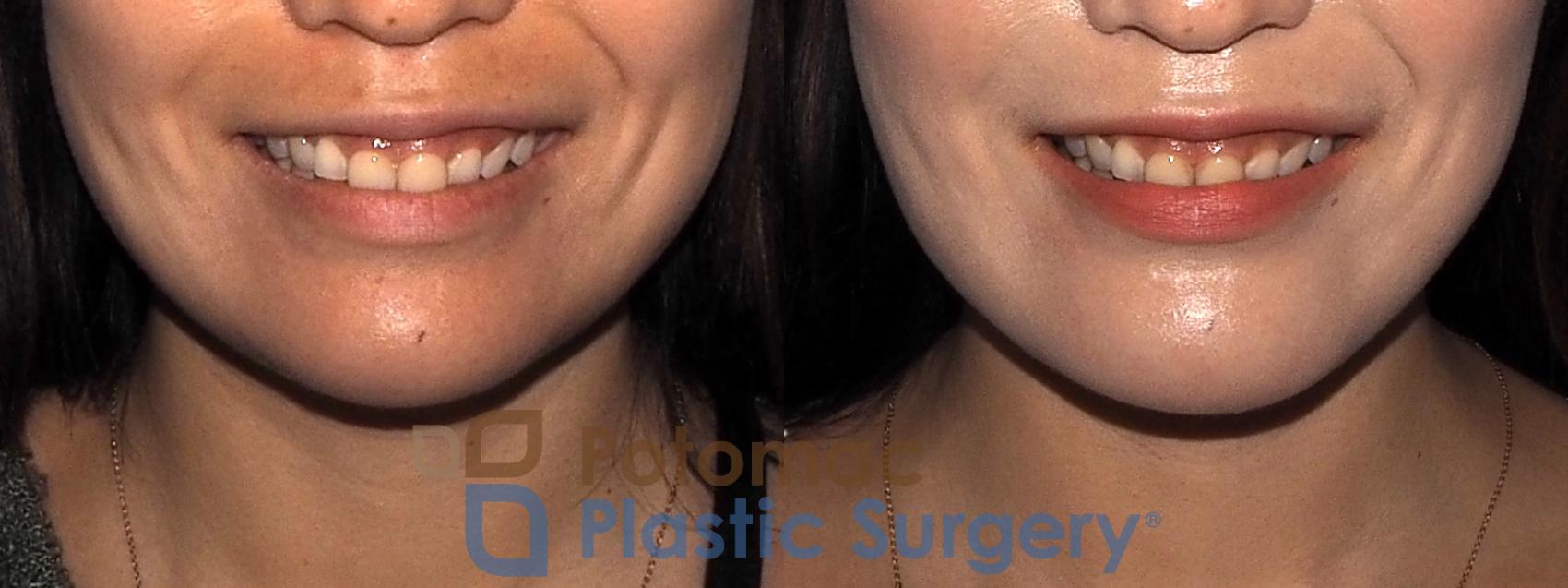 Before & After Chin Augmentation Case 214 Front View #2 View in Washington, DC
