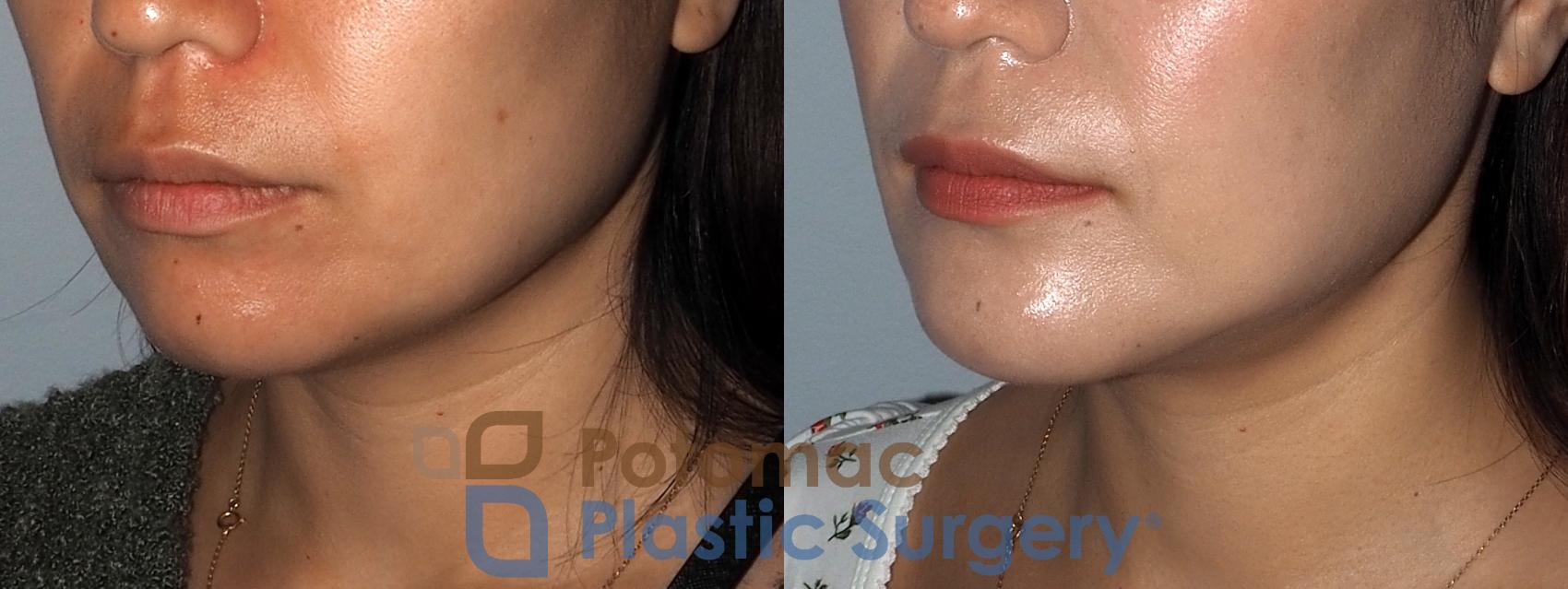Before & After Chin Augmentation Case 214 Left Oblique View in Washington, DC
