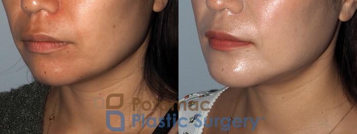 Before & After Chin Augmentation Case 214 Left Oblique View in Washington DC & Arlington , DC