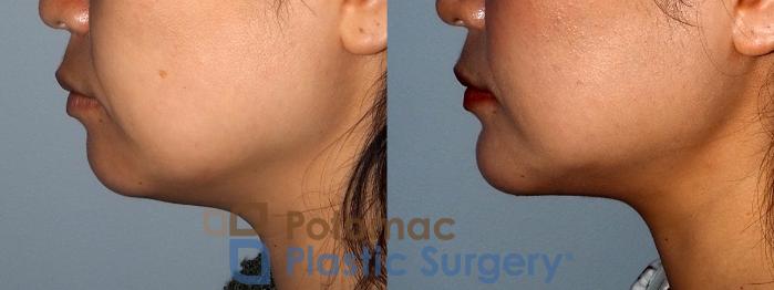 Before & After Chin Augmentation Case 214 Left Side View in Washington DC & Arlington , DC