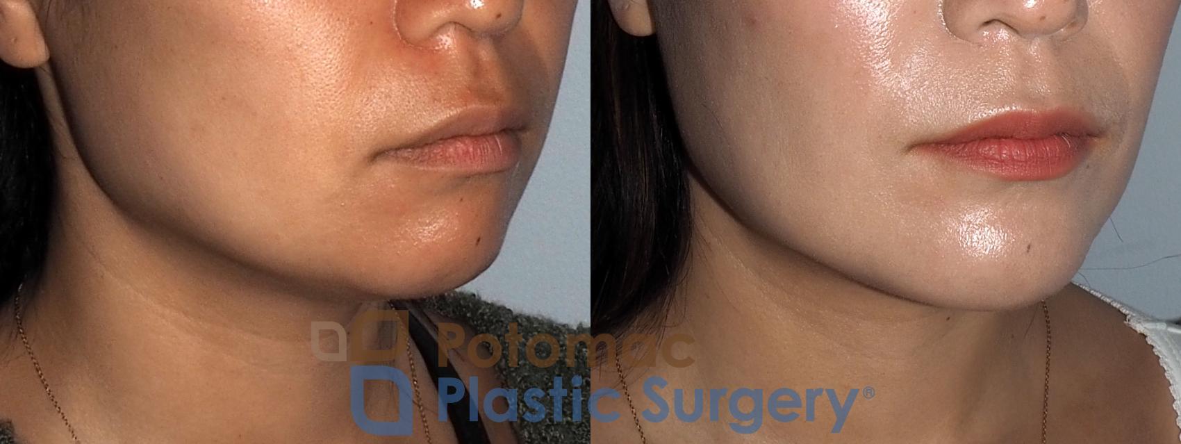 Before & After Chin Augmentation Case 214 Right Oblique View in Washington, DC