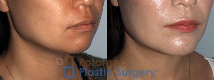 Before & After Chin Augmentation Case 214 Right Oblique View in Washington DC & Arlington , DC