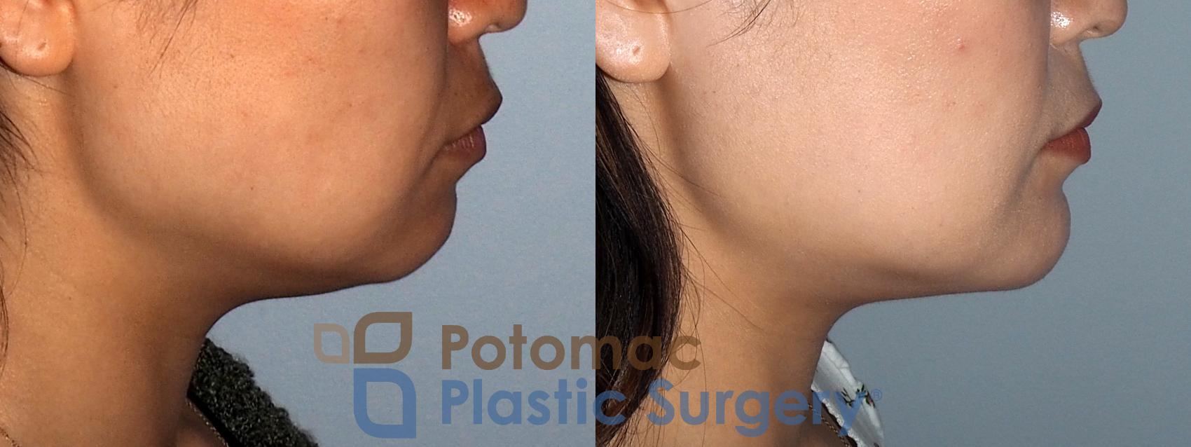 Before & After Chin Augmentation Case 214 Right Side View in Washington, DC