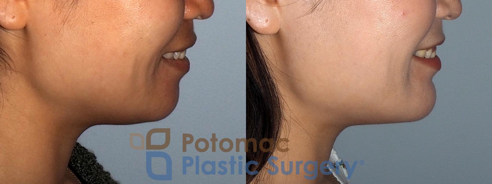 Before & After Chin Augmentation Case 214 Right Side View #2 View in Washington, DC