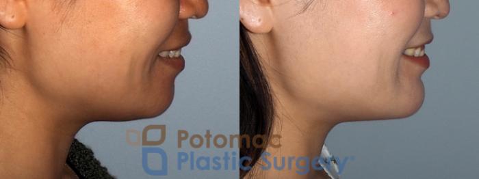 Before & After Liposuction Case 214 Right Side View #2 View in Washington DC & Arlington , DC