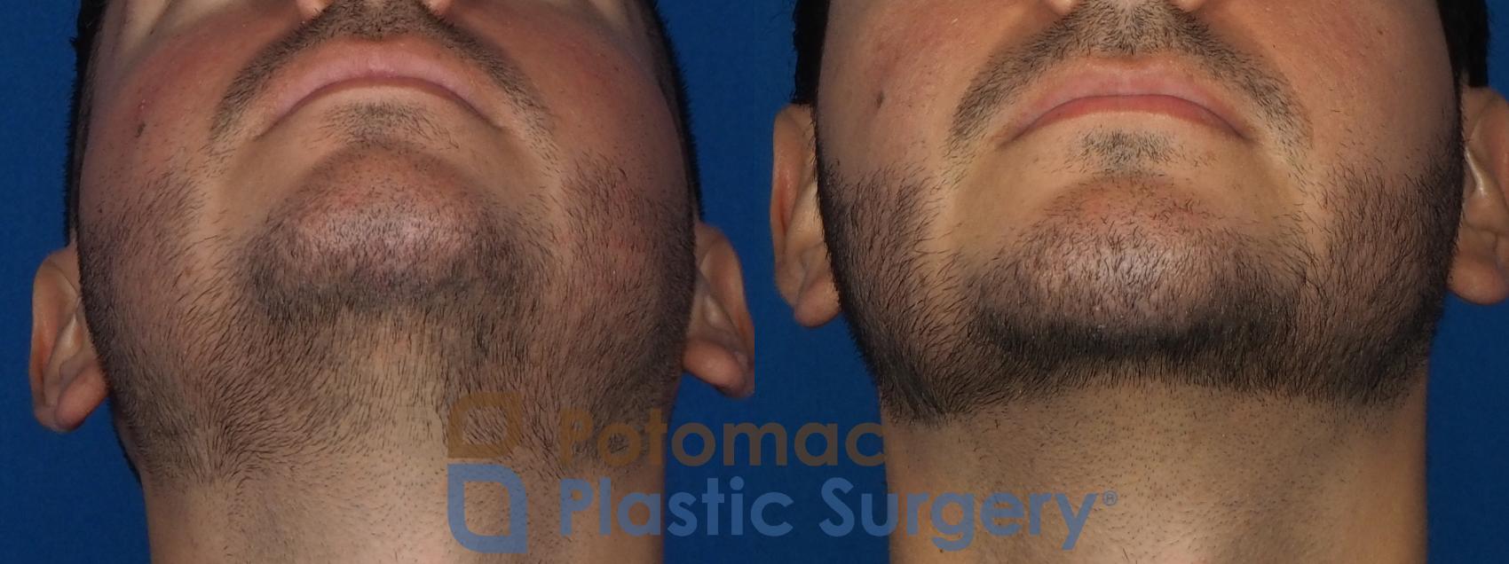 Before & After Chin Augmentation Case 233 Bottom View in Washington, DC