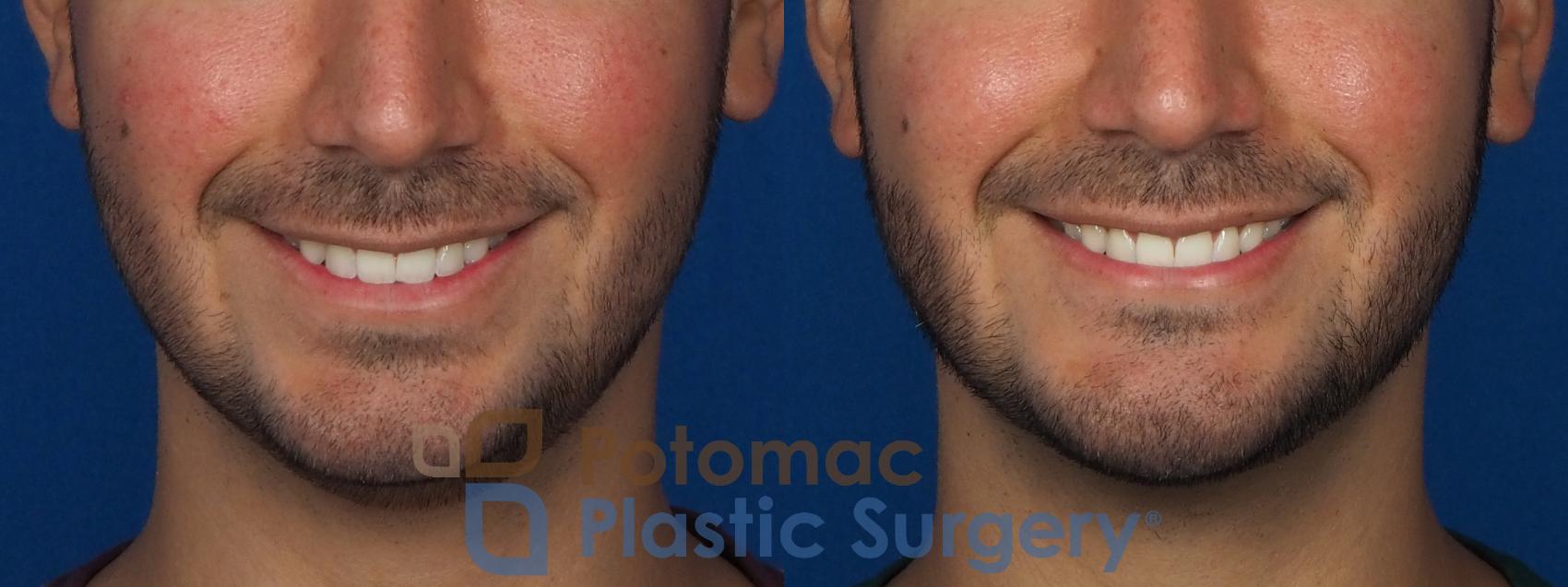 Before & After Chin Augmentation Case 233 Front - Smiling View in Washington, DC