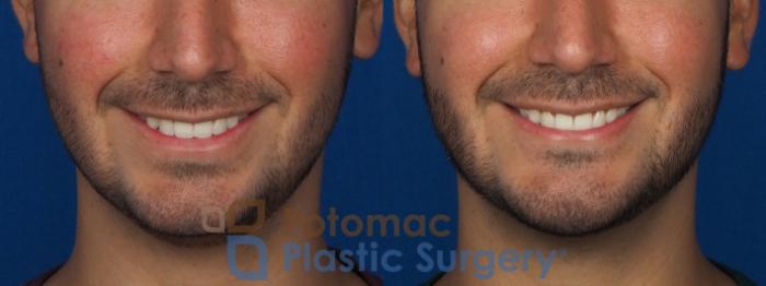 Before & After Dermal Fillers Case 233 Front - Smiling View in Washington, DC