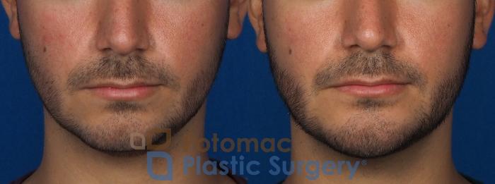 Before & After Dermal Fillers Case 233 Front View in Washington, DC
