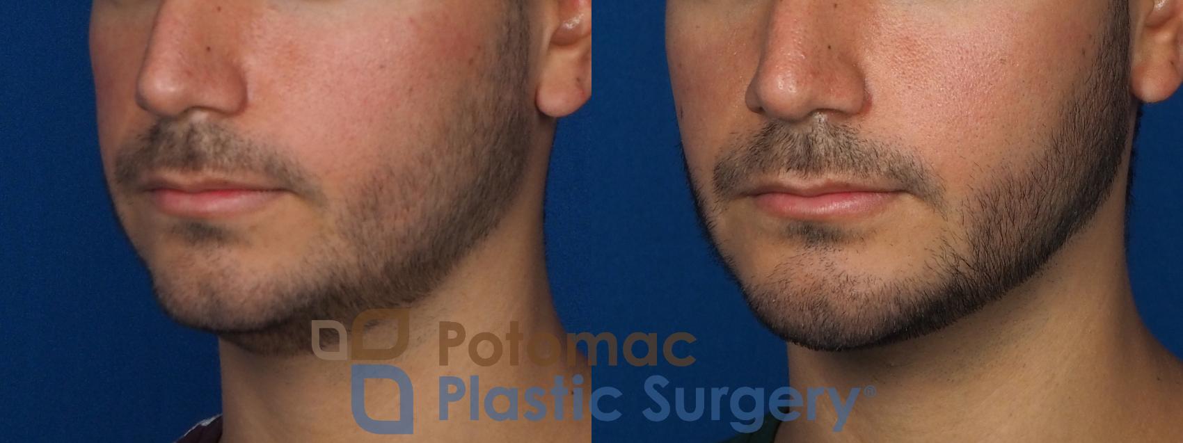 Before & After Chin Augmentation Case 233 Left Oblique View in Washington, DC