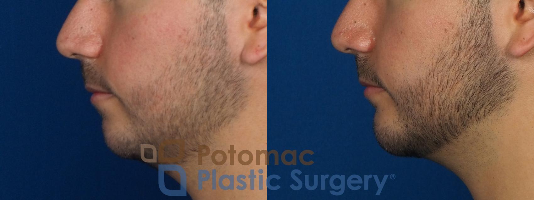 Before & After Chin Augmentation Case 233 Left Side View in Washington, DC