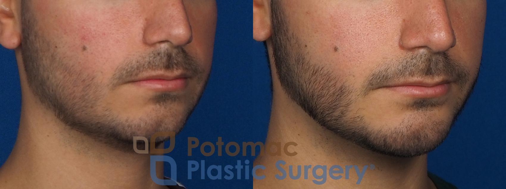 Before & After Chin Augmentation Case 233 Right Oblique View in Washington, DC