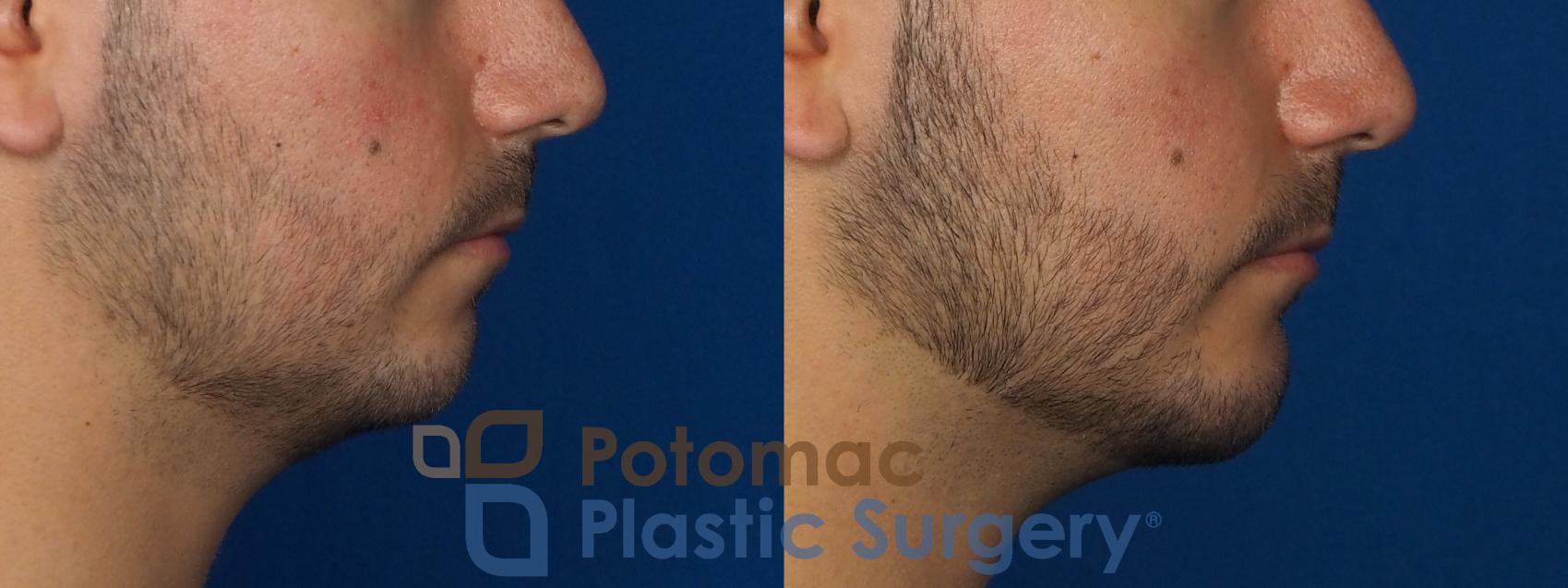 Before & After Chin Augmentation Case 233 Right Side View in Washington, DC