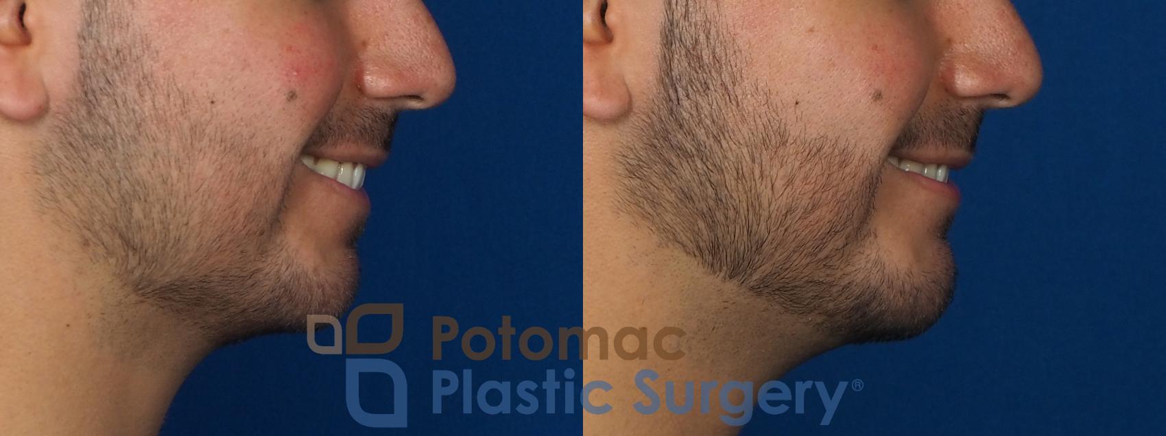 Before & After Chin Augmentation Case 233 Right Side - Smiling View in Washington, DC