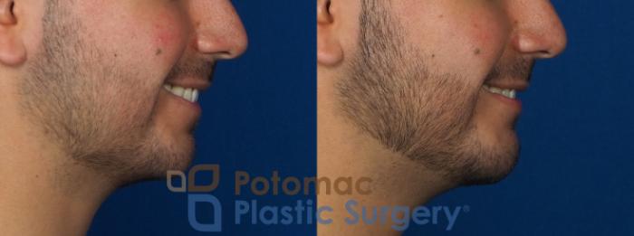 Before & After Dermal Fillers Case 233 Right Side - Smiling View in Washington, DC