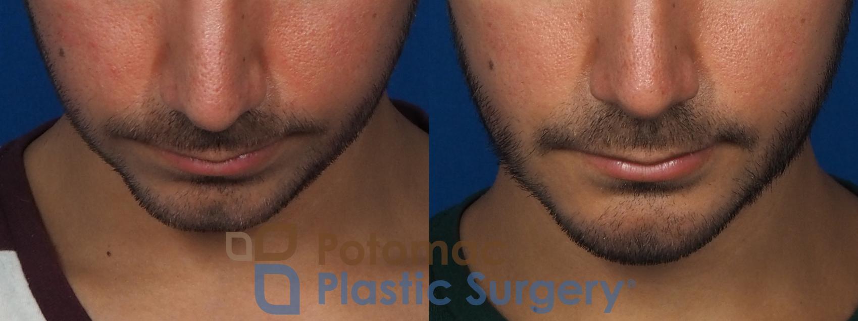 Before & After Chin Augmentation Case 233 Top View in Washington, DC