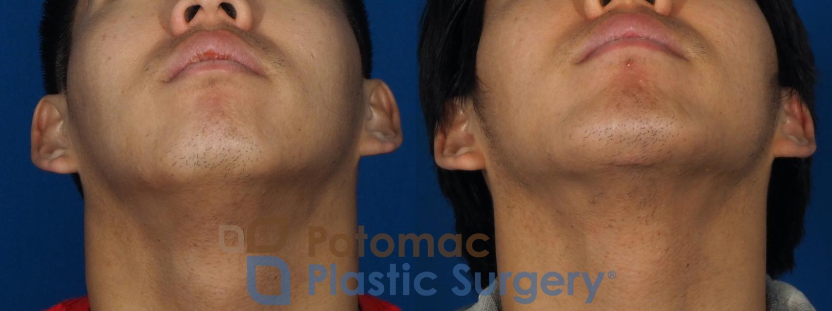 Before & After Chin Augmentation Case 241 Bottom View in Washington, DC