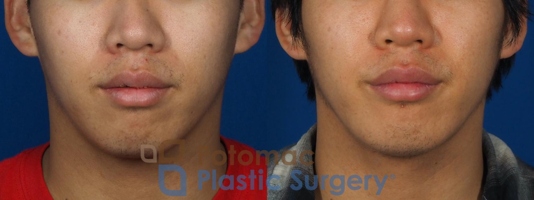 Before & After Chin Augmentation Case 241 Front View in Washington, DC