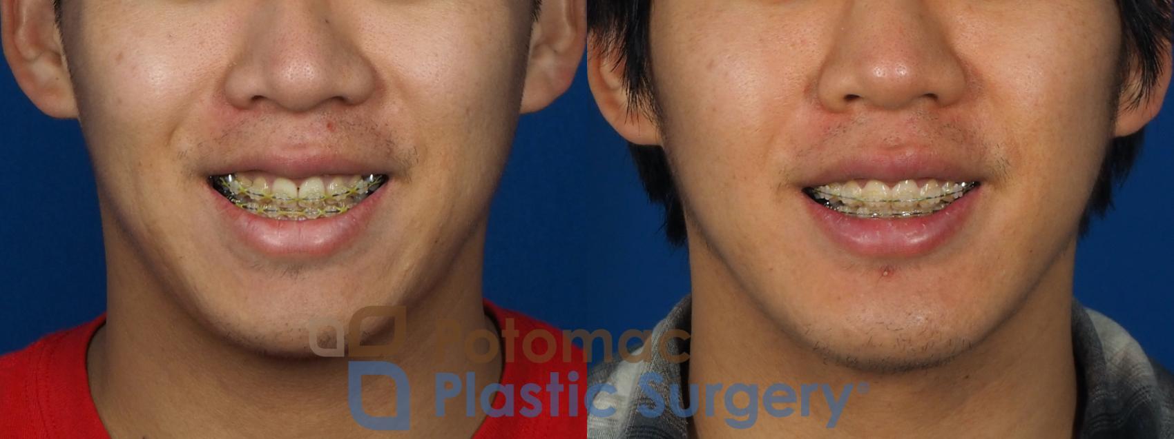 Before & After Chin Augmentation Case 241 Front - Smiling View in Washington, DC
