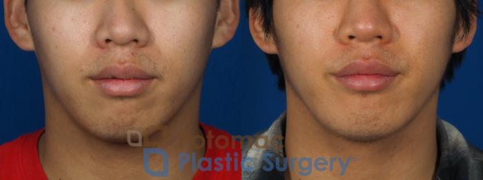Before & After Chin Augmentation Case 241 Front View in Washington DC & Arlington , DC