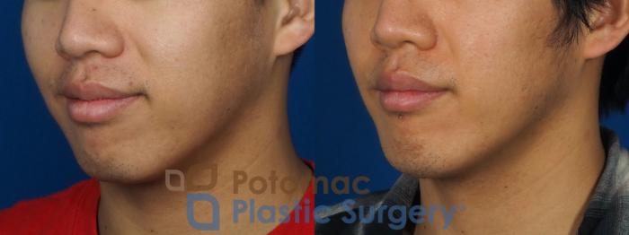 Before & After Chin Augmentation Case 241 Left Oblique View in Washington DC & Arlington , DC