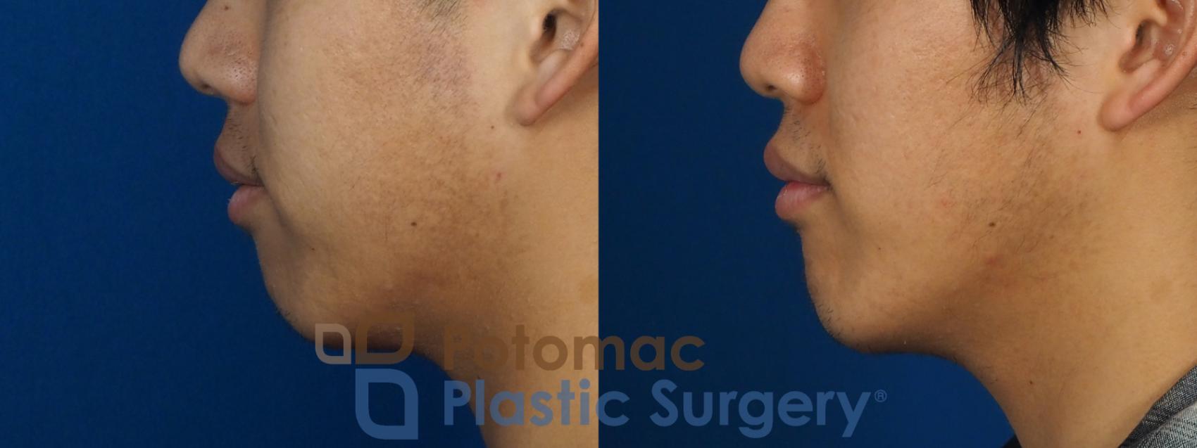 Before & After Chin Augmentation Case 241 Left Side View in Washington, DC