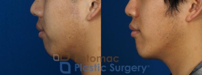 Before & After Chin Augmentation Case 241 Left Side View in Washington DC & Arlington , DC
