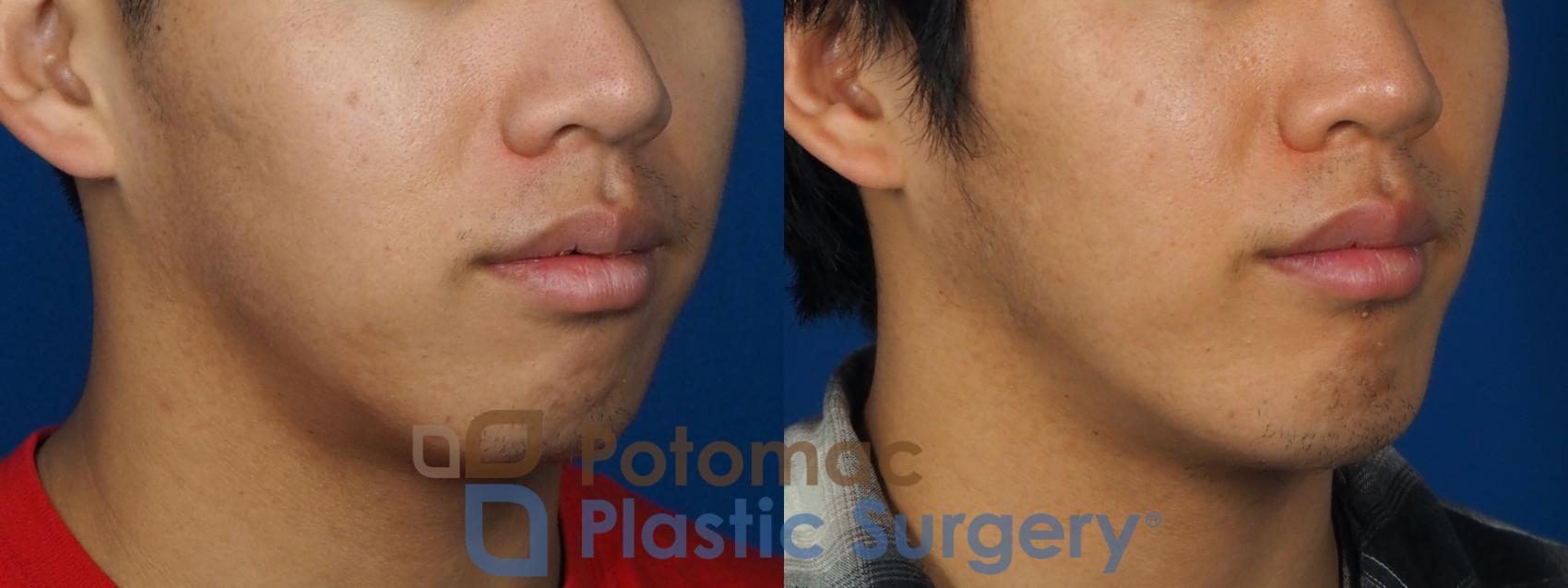 Before & After Chin Augmentation Case 241 Right Oblique View in Washington, DC