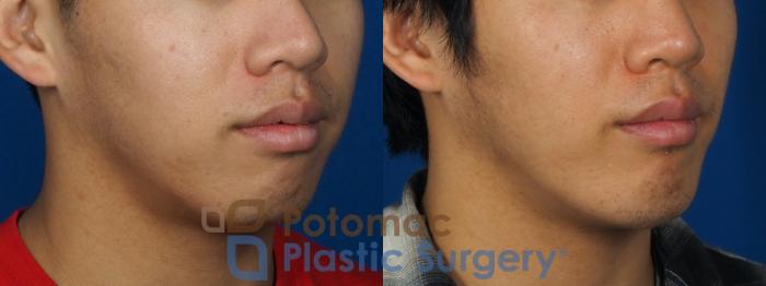 Before & After Facial Sculpting Case 241 Right Oblique View in Washington DC & Arlington , DC
