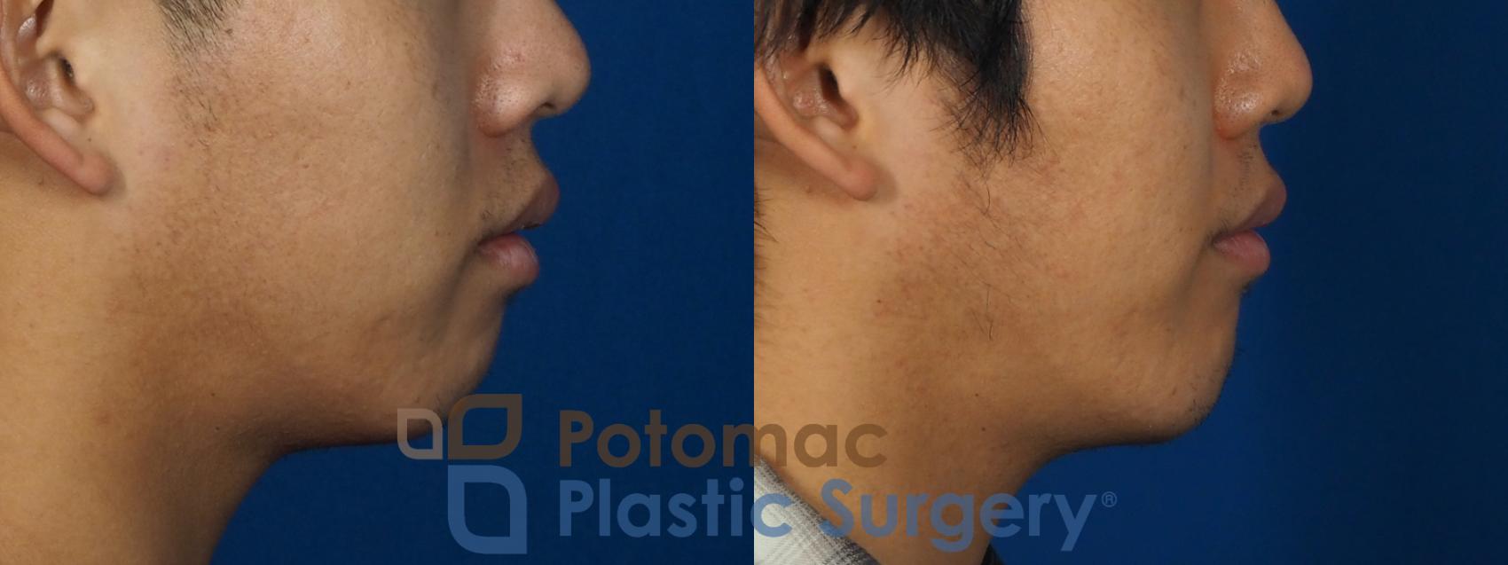 Before & After Chin Augmentation Case 241 Right Side View in Washington, DC