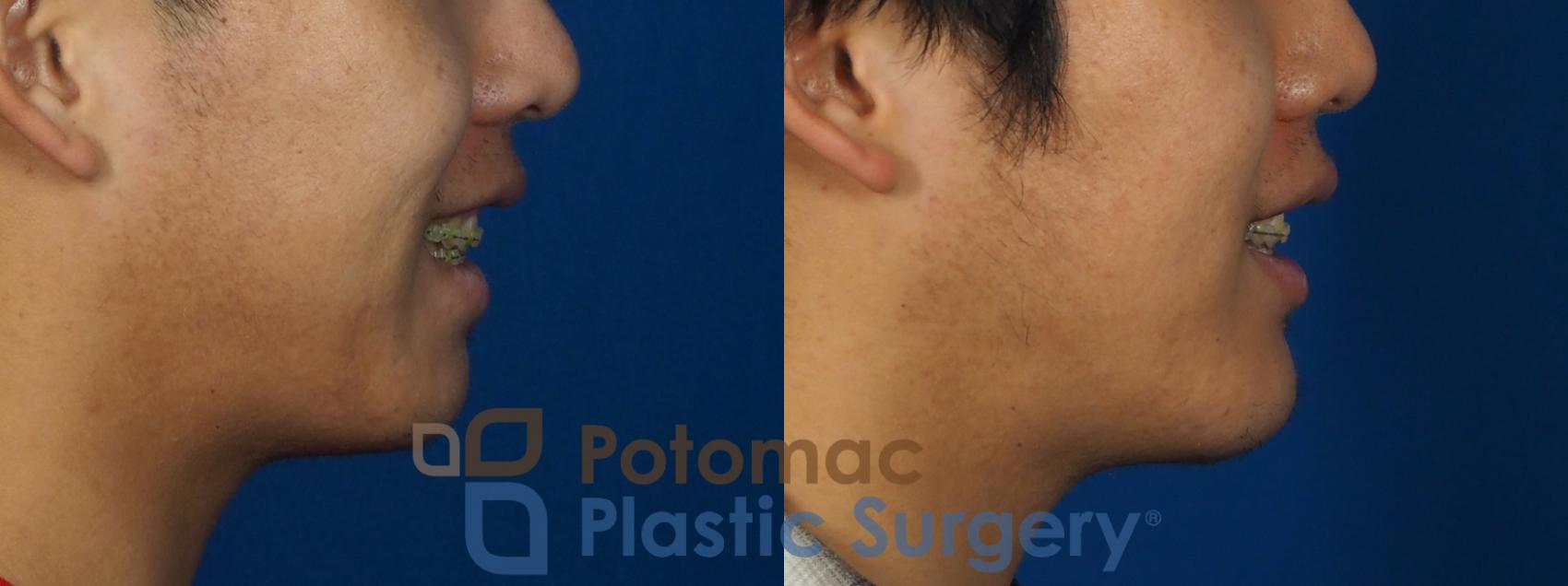 Before & After Chin Augmentation Case 241 Right Side - Smiling View in Washington, DC