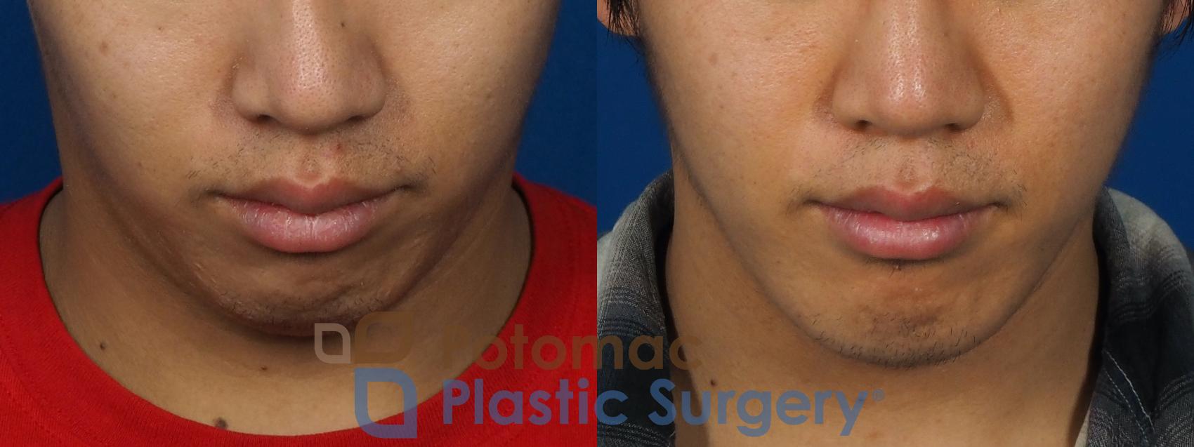 Before & After Chin Augmentation Case 241 Top View in Washington, DC