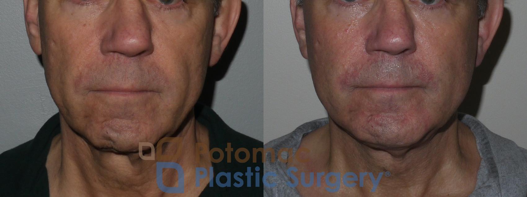 Before & After Chin Augmentation Case 258 Front View in Washington, DC